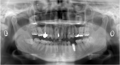 阿久井5　埋入直後・抜歯後約2.5ヶ月